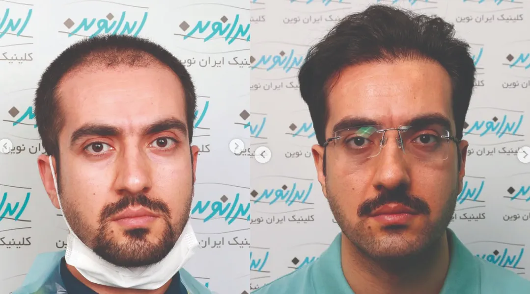 بهترین مرکز کاشت مو غرب تهران