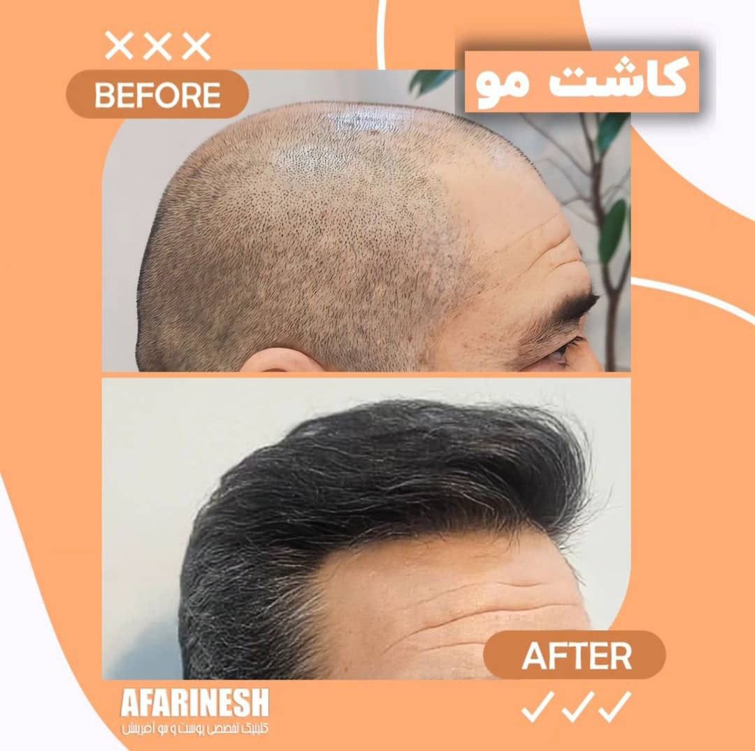 کاشت مو در مشهد